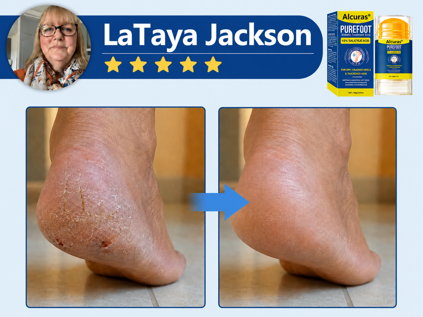 Last Day 49% OFF🔥Alcuras® Pure Foot Diabetes Treatment Stick