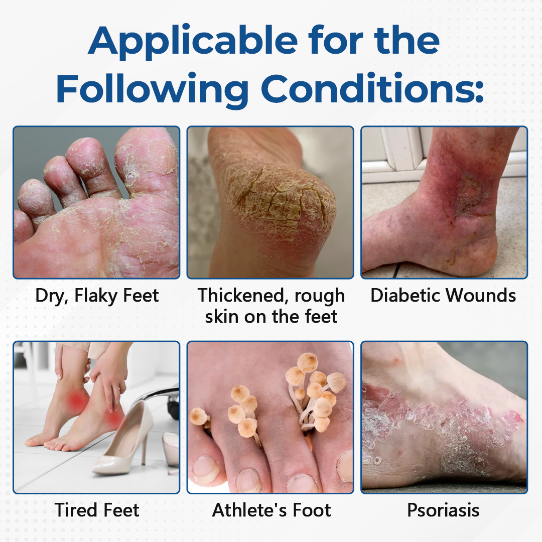 Last Day 49% OFF🔥Alcuras® Pure Foot Diabetes Treatment Stick