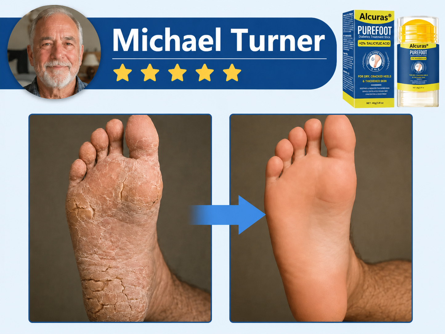 Last Day 49% OFF🔥Alcuras® Pure Foot Diabetes Treatment Stick