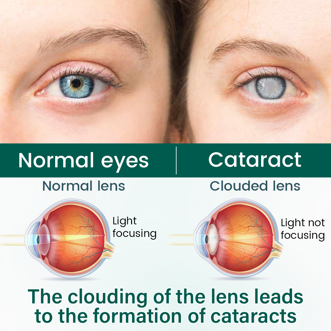 Alcuras® OptiClear Nano Eye Roller Serum