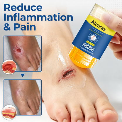 Last Day 49% OFF🔥Alcuras® Pure Foot Diabetes Treatment Stick